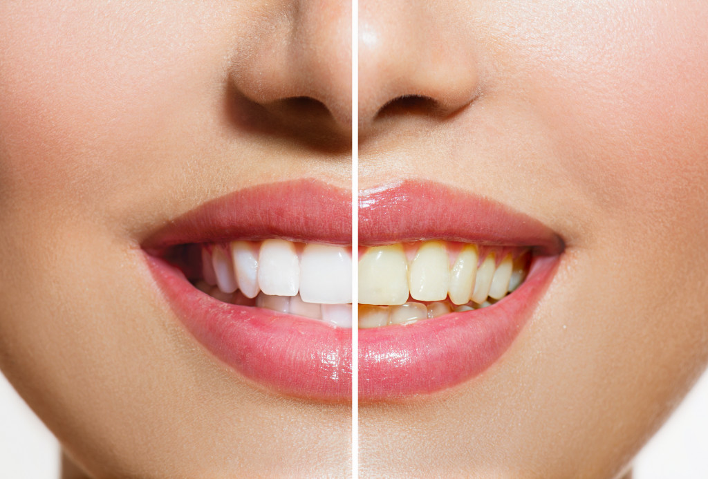 Before and after treatment of teeth whitening of a smiling woman