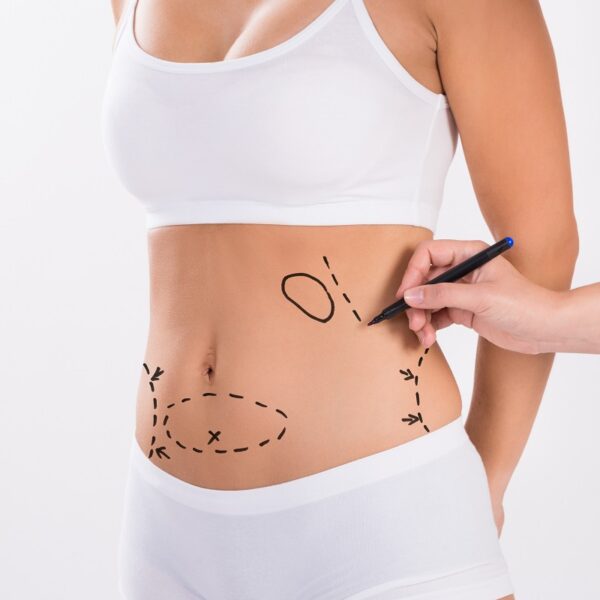 How To Get Liposuction Covered By Insurance